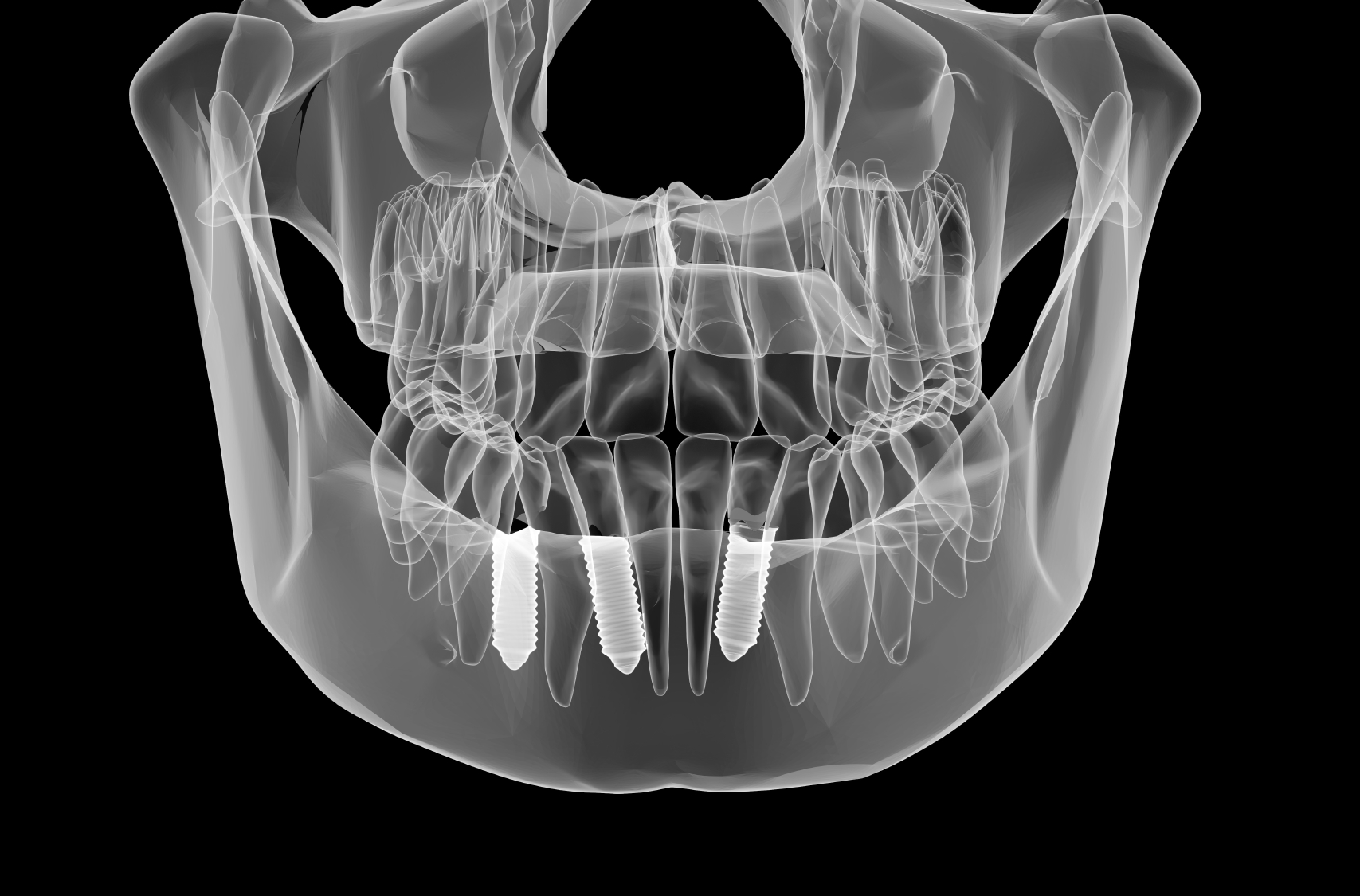 Dental Implant Xray